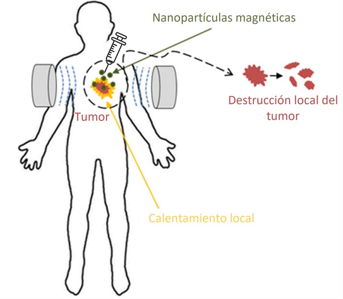 hipertermia