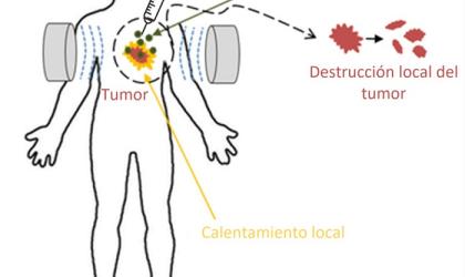 hipertermia